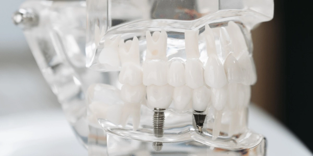 Step-by-Step Guide to Getting Dental Bridges or Implants: What to Expect