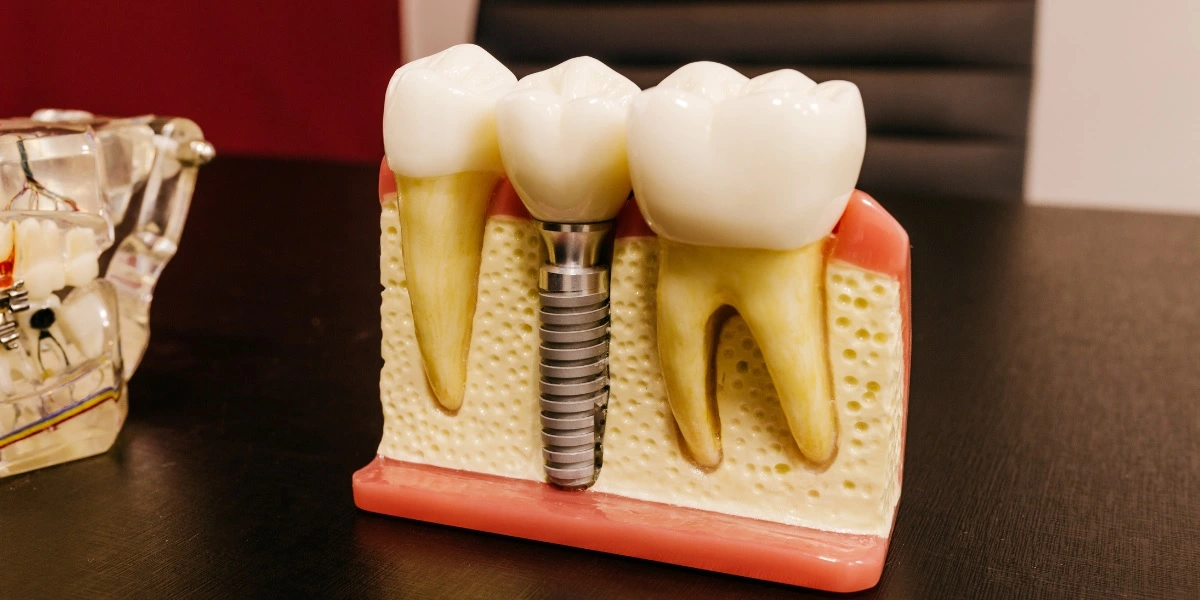 Types of Dental Implants Available & Other Supporting Procedures